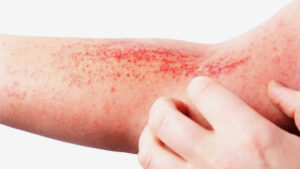 إيلي ليلي ترسم خريطة جديدة لعلاج الإكزيما: EBGLYSS يحقق فعالية مستدامة بجرعات نصف شهرية لتخفيف عبء المرض المزمن